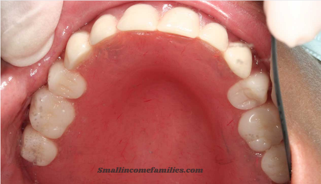 A Dental Crown Cost Without Insurance